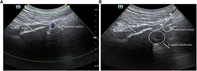 The impact of combined administration of ropivacaine and dexamethasone on postoperative analgesia in perianal surgery with pudendal nerve block under ultrasound guidance: a prospective randomized controlled study